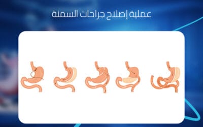 عملية إصلاح جراحات السمنة