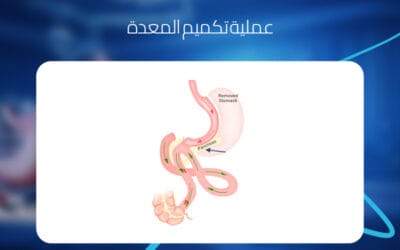 عملية تكميم المعدة