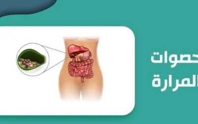 حصوات المرارة