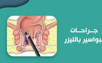 جراحات البواسير بالليزر